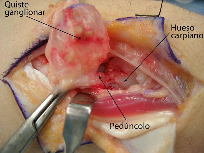 Ganglion